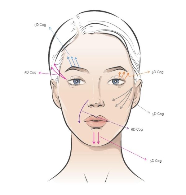 Rainbow Threads Rainbow 5D Cog 4x draadlift dermal filler oreon life science explanation 2