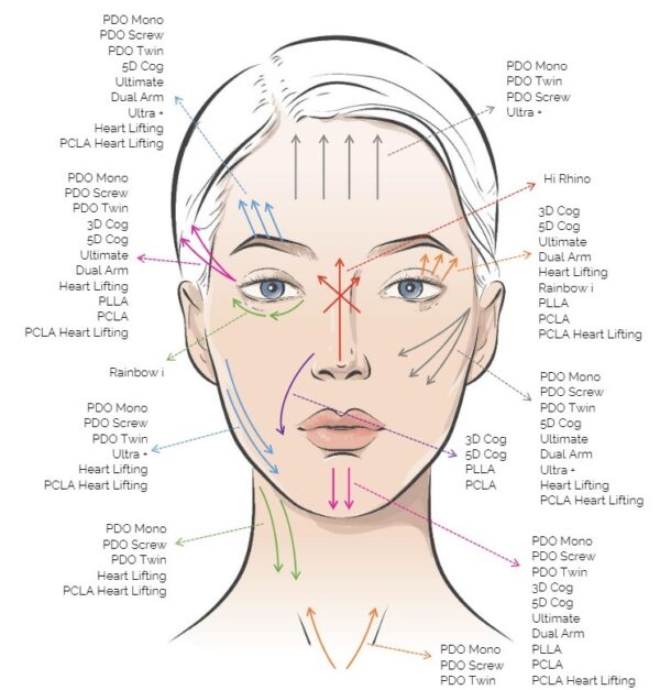 Rainbow Threads Rainbow Eye 4x draadlift dermal filler oreon life science explanation