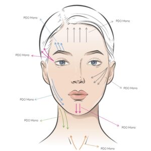 Rainbow Threads Rainbow PDO Mono 4x draadlift dermal filler oreon life science explanation