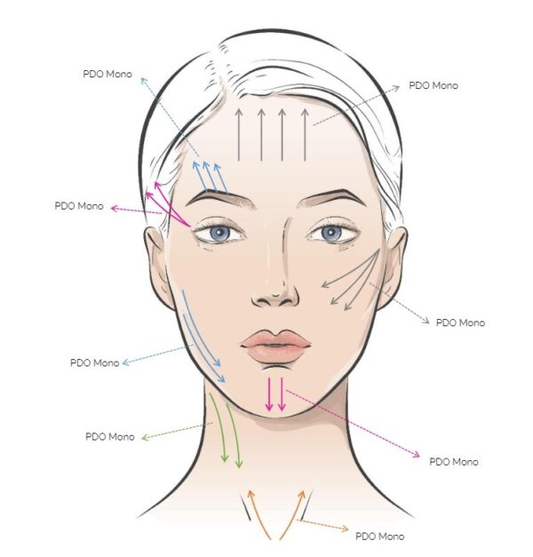 Rainbow Threads Rainbow PDO Mono 4x draadlift dermal filler oreon life science explanation